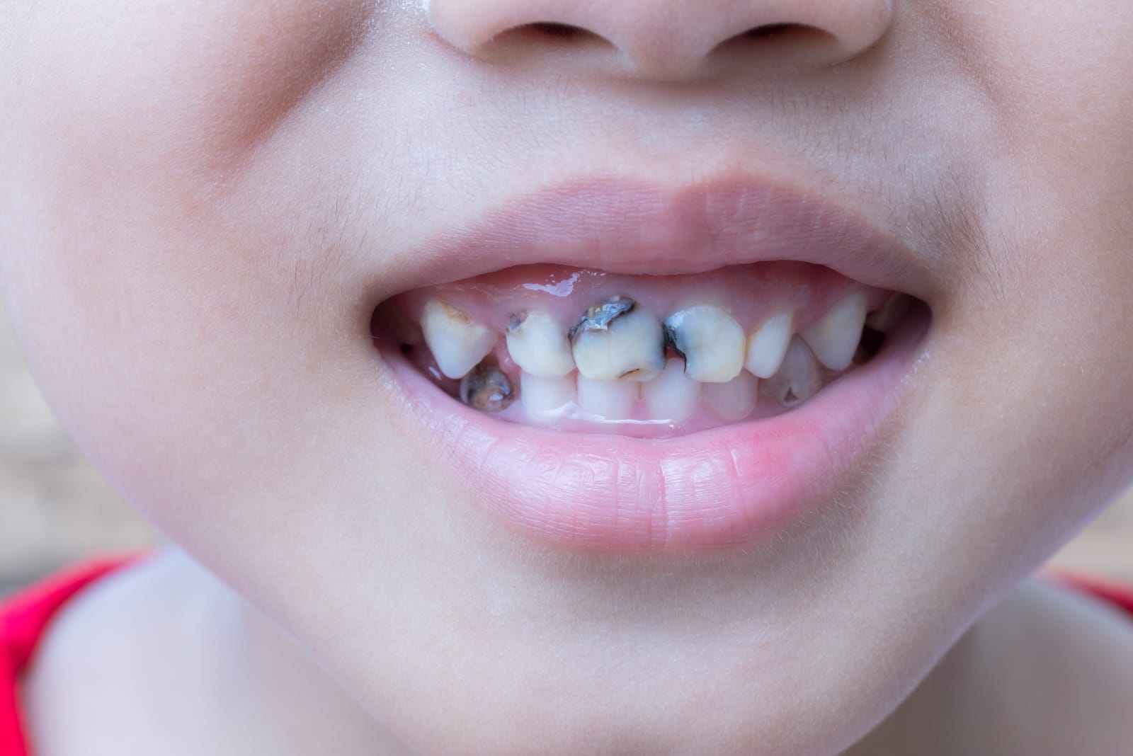 ママの虫歯とお子様の虫歯との関係