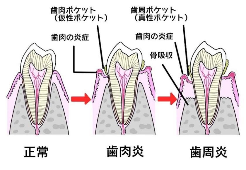 歯周病とは？