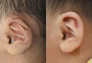 耳の矯正①