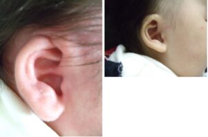 耳の矯正③