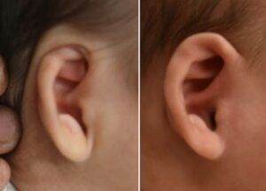 耳の矯正②