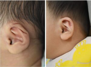 耳の矯正①